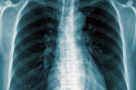 xray of chest